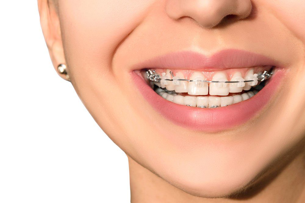 Various kinds of dental braces and their purpose - Family Dental